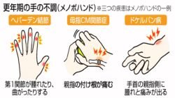 更年期手トラブル急増注意